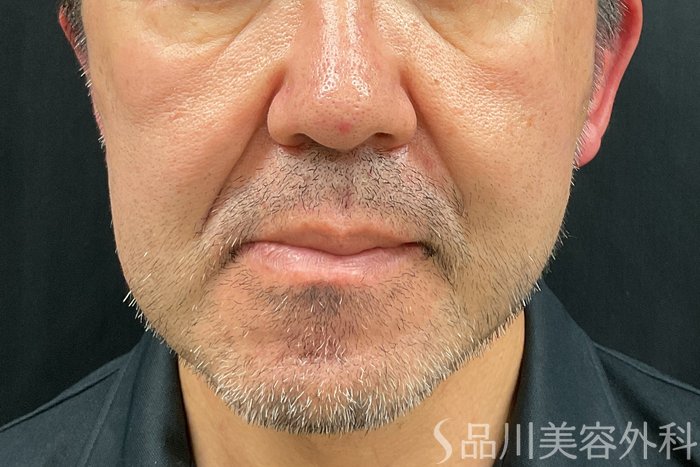 症例NO.71246のAFTER写真