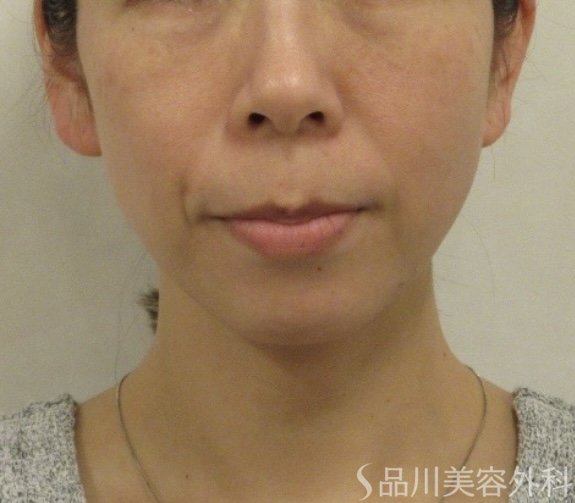 症例NO.73554のBEFORE写真