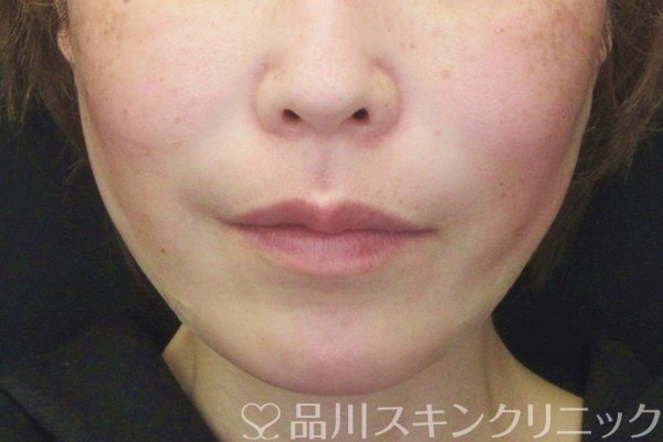 症例NO.65696のAFTER写真