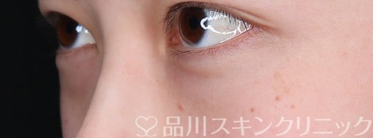 症例NO.65593のBEFORE写真