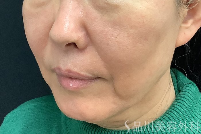 症例NO.71233のBEFORE写真