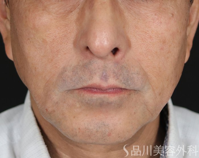 症例NO.71607のBEFORE写真