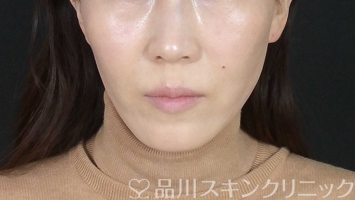 症例NO.72273のAFTER写真