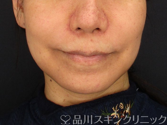 症例NO.69861のBEFORE写真