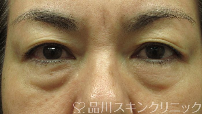 症例NO.69766のBEFORE写真