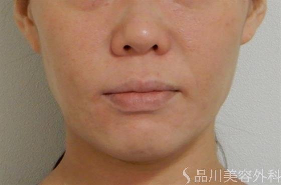 症例NO.38562のBEFORE写真