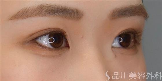 症例NO.50656のAFTER写真