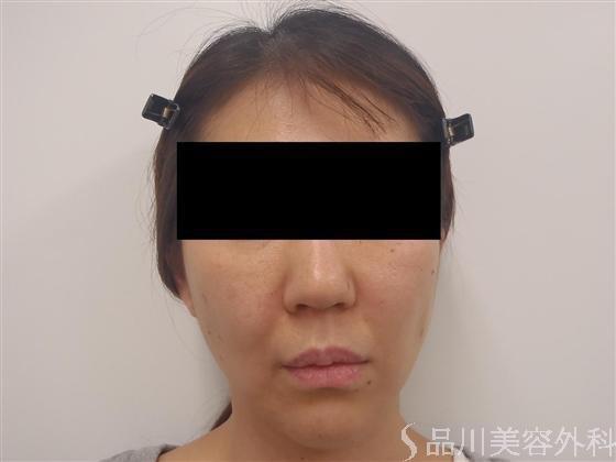症例NO.6263のBEFORE写真