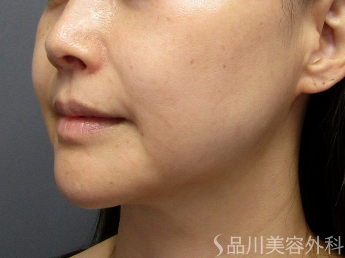 症例NO.74833のBEFORE写真