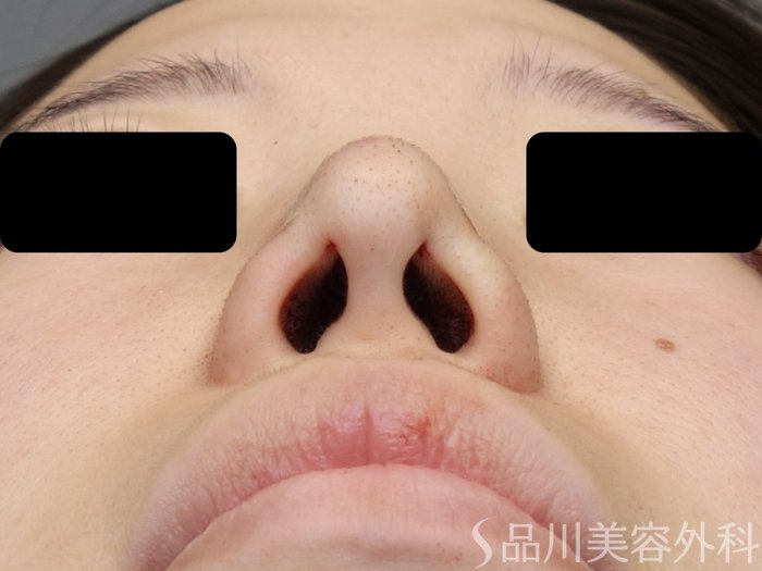 症例NO.70145のAFTER写真