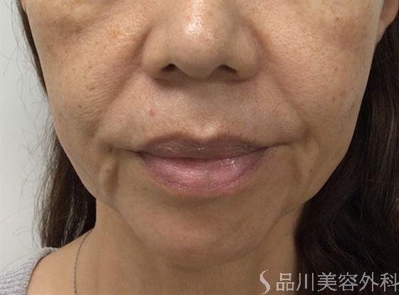 症例NO.56302のBEFORE写真