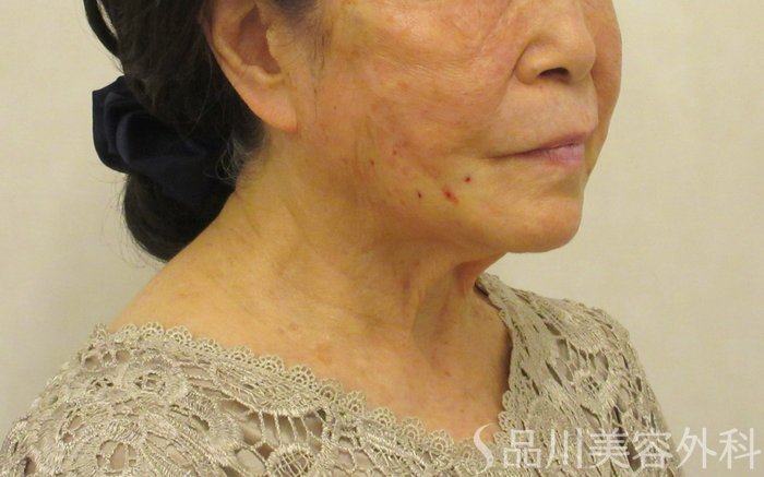 症例NO.72613のAFTER写真