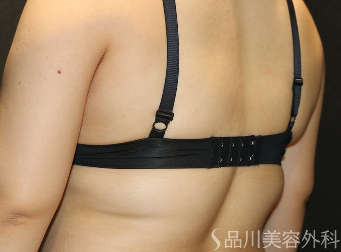 症例NO.74609のAFTER写真