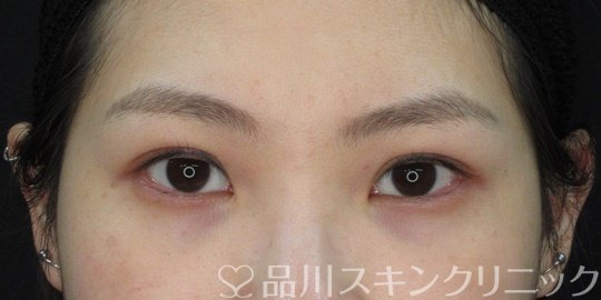 症例NO.72209のAFTER写真