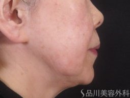 症例NO.73845のBEFORE写真