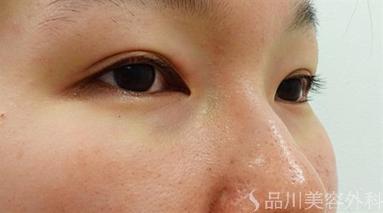 症例NO.36176のBEFORE写真