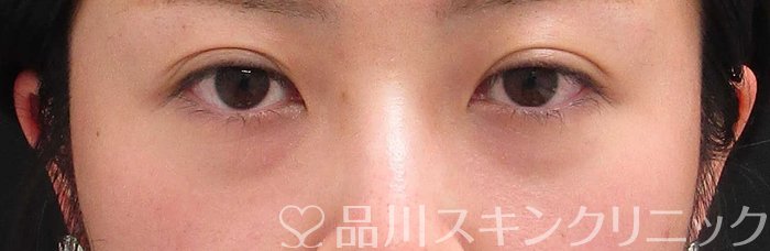 症例NO.63598のBEFORE写真