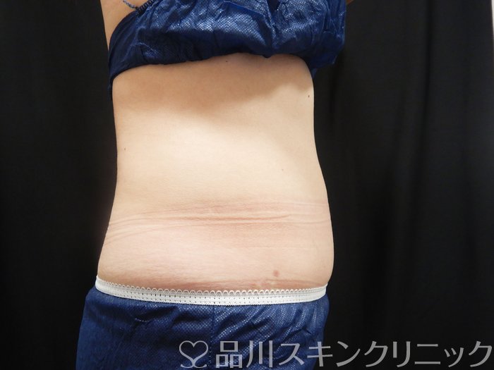 症例NO.74998のAFTER写真