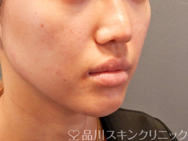症例NO.70029のBEFORE写真