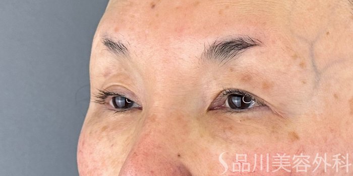 症例NO.72837のBEFORE写真