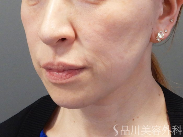 症例NO.74626のBEFORE写真