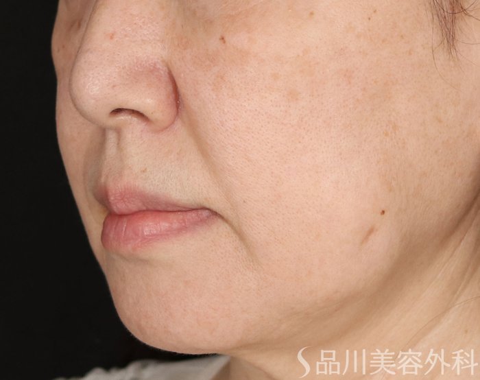 症例NO.71349のBEFORE写真