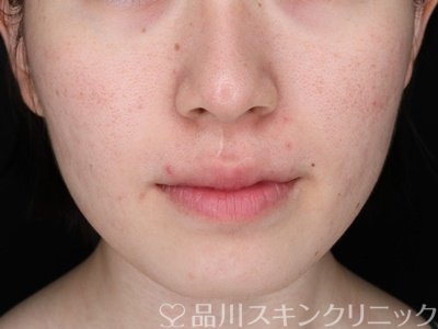 症例NO.71407のBEFORE写真