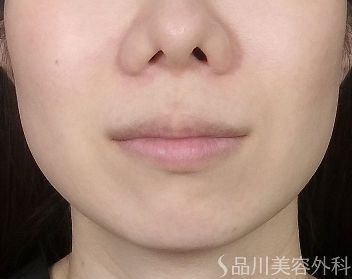 症例NO.67812のBEFORE写真