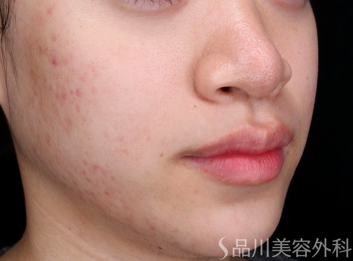 症例NO.72569のAFTER写真