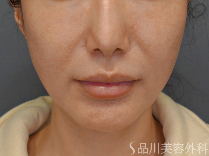 症例NO.73920のBEFORE写真