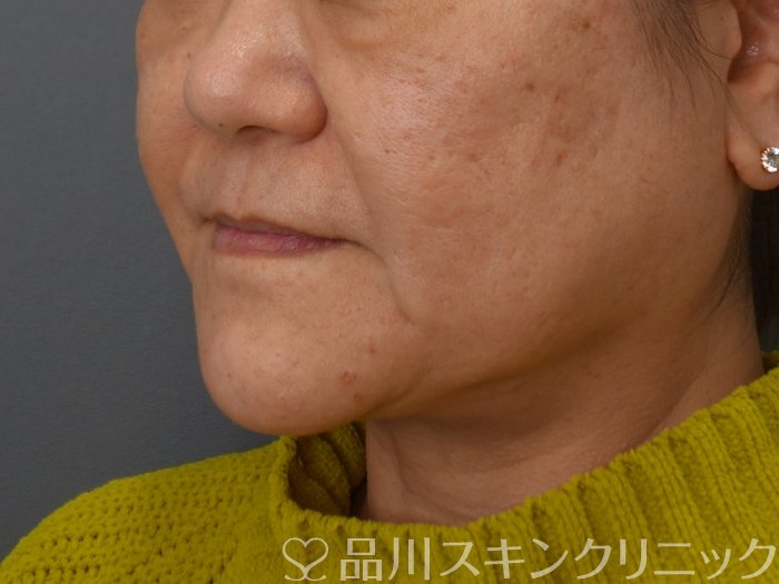 症例NO.74734のBEFORE写真