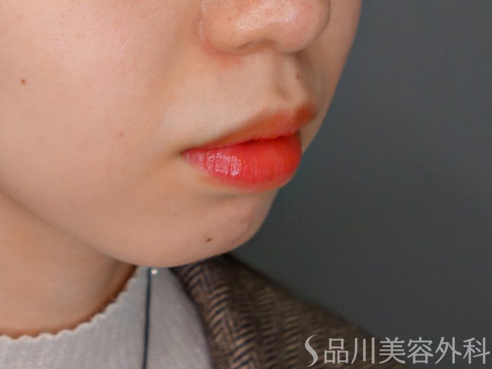 症例NO.69710のBEFORE写真