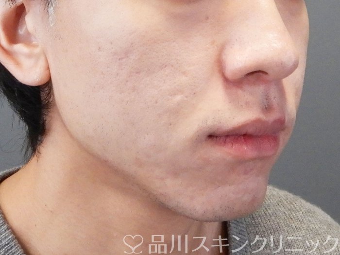 症例NO.73208のAFTER写真