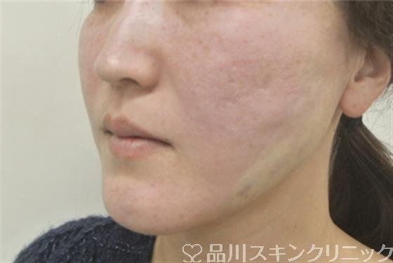 症例NO.31244のAFTER写真