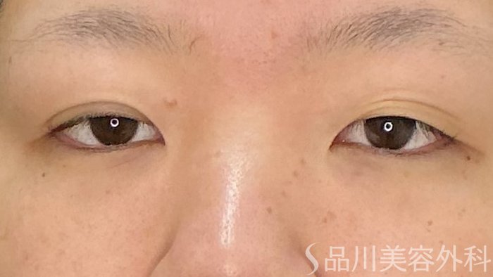 症例NO.71781のBEFORE写真