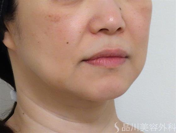 症例NO.39686のBEFORE写真