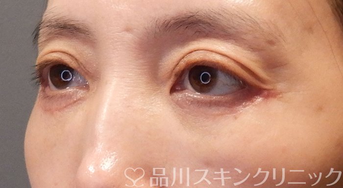 症例NO.70660のAFTER写真