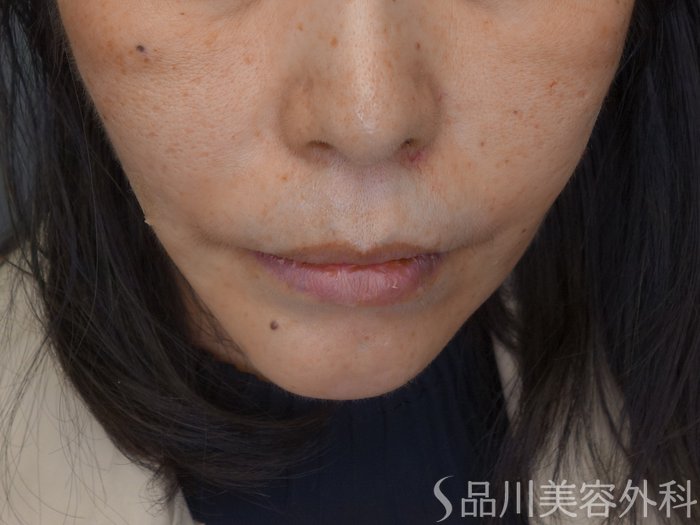 症例NO.69761のAFTER写真