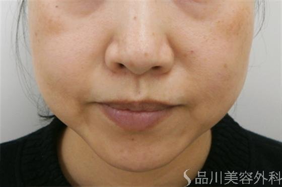症例NO.19548のBEFORE写真