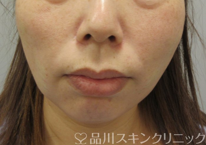 症例NO.71917のAFTER写真