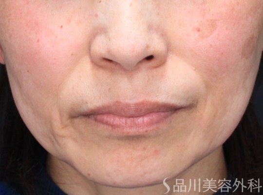 症例NO.68583のBEFORE写真