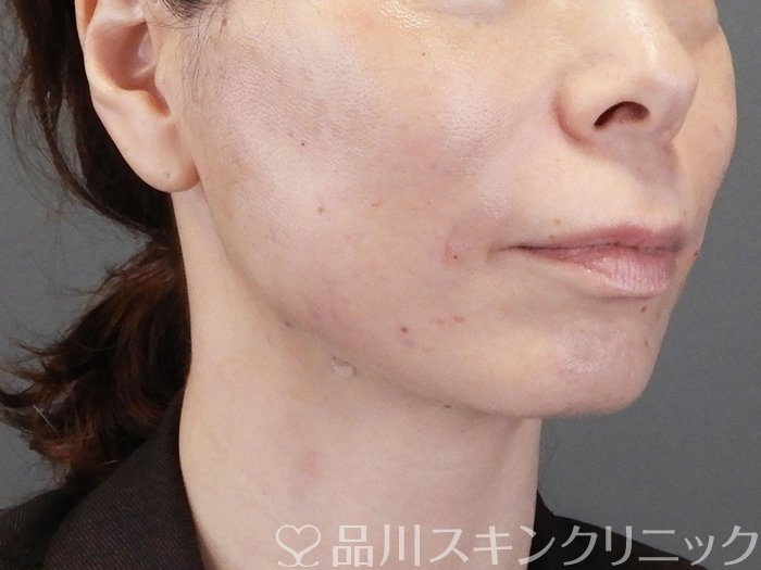 症例NO.75271のAFTER写真