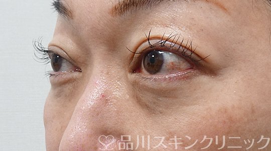 症例NO.62928のAFTER写真