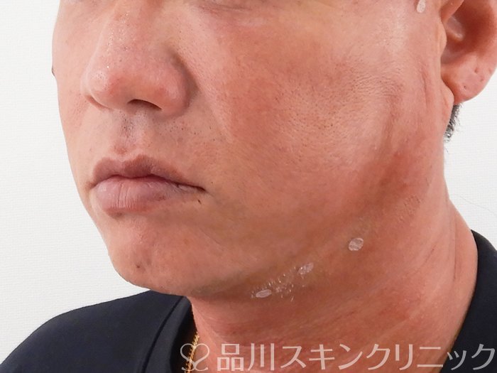 症例NO.62191のAFTER写真
