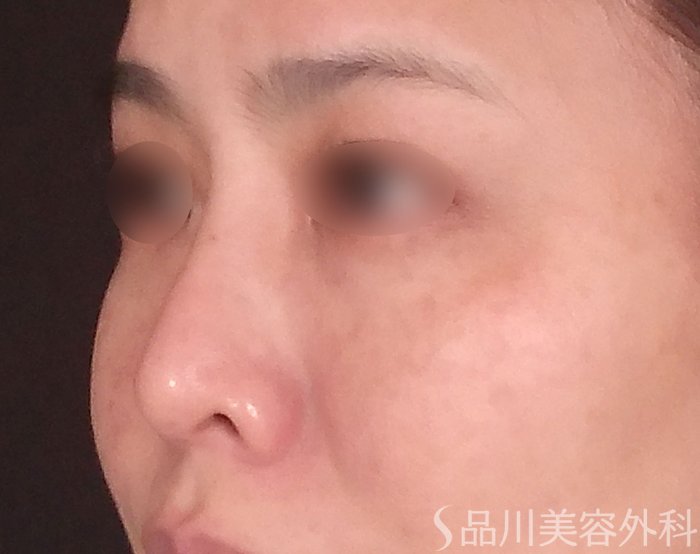症例NO.69811のBEFORE写真