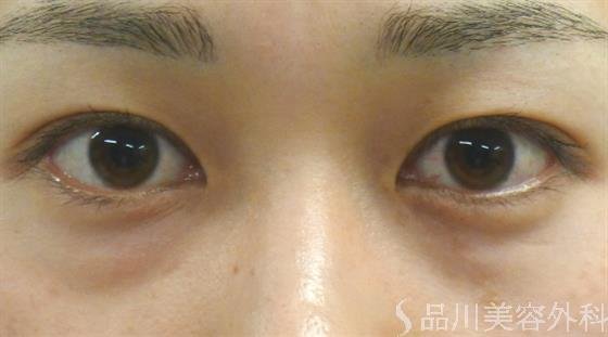 症例NO.40530のBEFORE写真