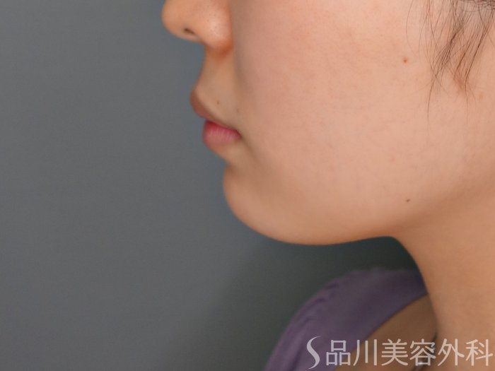 症例NO.68433のBEFORE写真