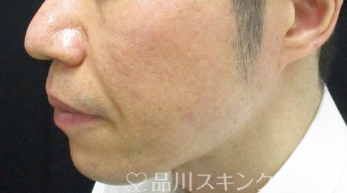 症例NO.69680のAFTER写真