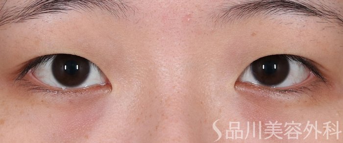 症例NO.71075のBEFORE写真