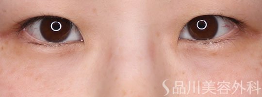 症例NO.65389のBEFORE写真